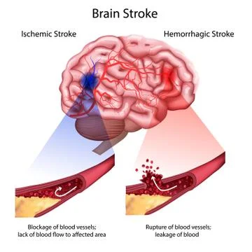 Stroke types poster, banner. Vector medical illustration. white background Stock Illustration