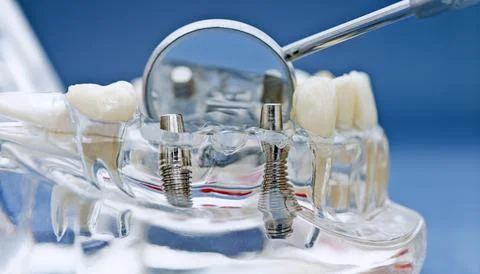 Structure of artificial teeth. Dental model with titanium screw implants in c 스톡 사진