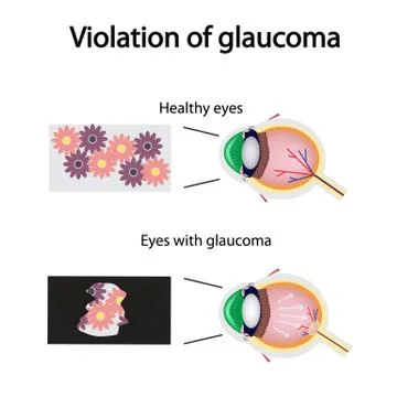 The structure of the eye. Blurred vision in glaucoma. As the eye can see the Stock Illustration