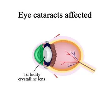The structure of the eye. Eye cataracts affected. Violations occur when a Stock Illustration