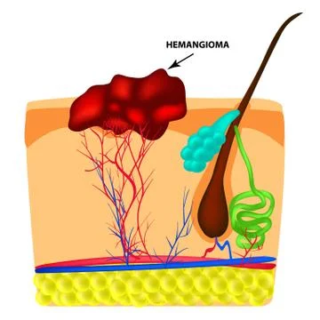 Structure Hemangeoma. The structure of the red mole on the skin. Birthmark Stock Illustration