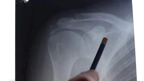 Structure of the human shoulder joint 動画素材 77847038