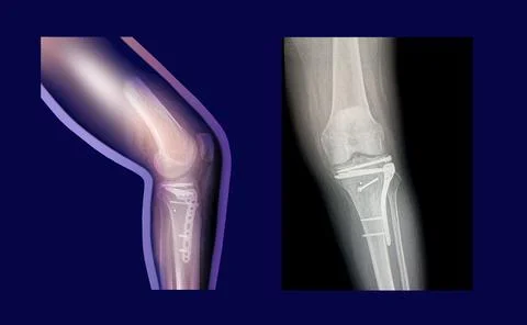Structure of knee and rx-ray image of knee, tibia fracture with post operat.. Stock Illustration