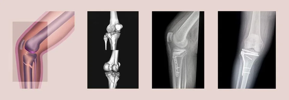 Structure of knee and rx-ray image of knee, tibia fracture with post operatio Stock Illustration