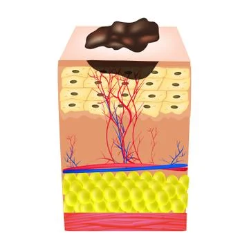 The structure of the nevus. The structure of moles on the skin. Infographics Stock Illustration