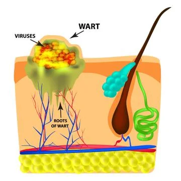 The structure of the wart. The structure of the skin. Infographics. Vector Stock Illustration