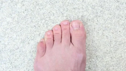 Stubbed toe top down view, injured pinky toe Stock Footage 285789949