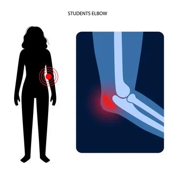 Student elbow bursitis Stock Illustration