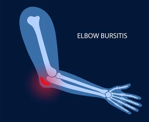 Student elbow bursitis Stock Illustration