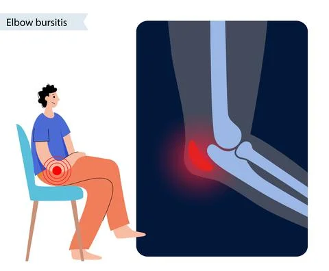 Student elbow bursitis Stock Illustration