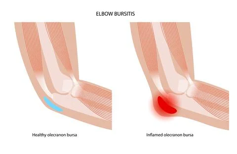 Student elbow bursitis Stock Illustration