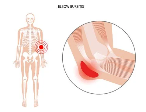 Student elbow bursitis Stock Illustration