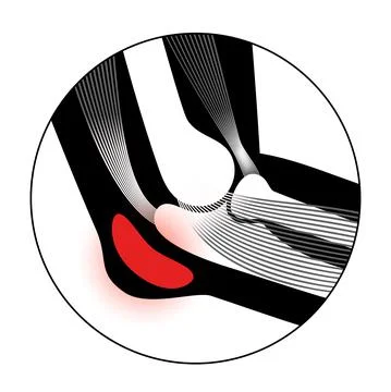 Student elbow bursitis Stock Illustration
