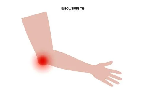 Student elbow bursitis Stock Illustration