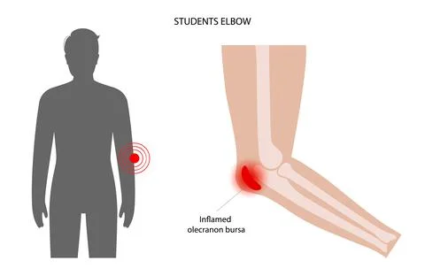 Student elbow bursitis Stock Illustration