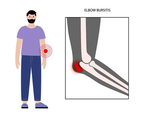Student elbow bursitis Stock Illustration