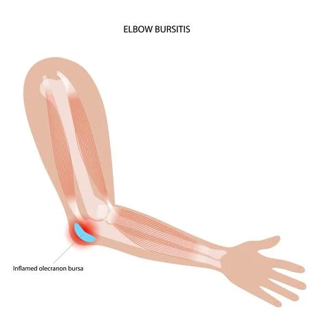 Student elbow bursitis Stock Illustration