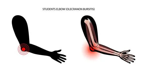 Student elbow bursitis Stock Illustration
