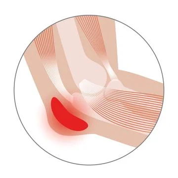 Student elbow bursitis Stock Illustration