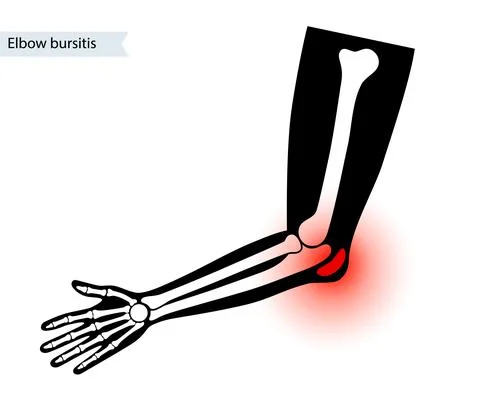 Student elbow bursitis Stock Illustration