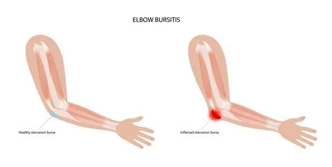 Student elbow bursitis Stock Illustration