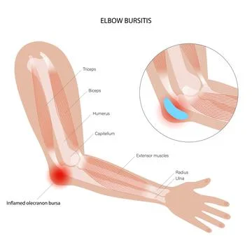 Student elbow bursitis Stock Illustration
