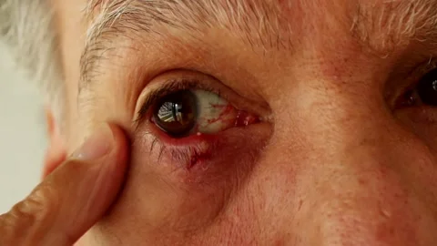 Stye on Eye Stock Footage 150514058