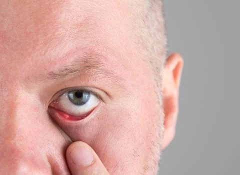 Stye in the eye Stock Photos