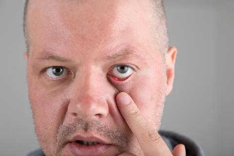 Stye in the eye Stock Photos