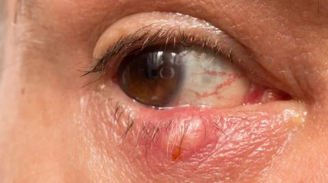 Stye on Eye Stock Photos