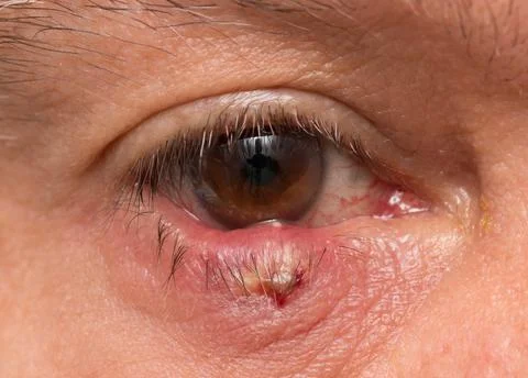 Stye on Eye Stock Photos