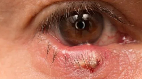 Stye on Eye Stock Photos