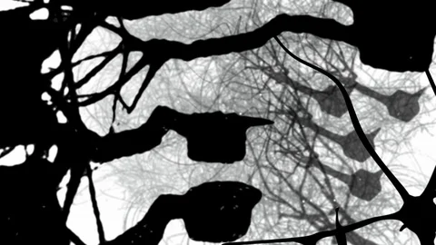 Stylized depiction: Neurons in the brain begin to collapse Stock Footage 92436739