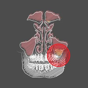 Stylized hatching of the Odontogenic sinusitis. Inflammation of the maxillary Illustrazione stock
