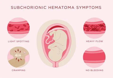 Subchorionic hematoma symptoms infographic Stock Illustration