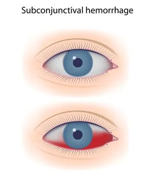 Subconjunctival hemorrhage Stock Illustration