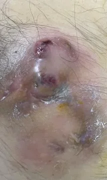 Subcutaneous Abscess from Pilonidal Sinus  1 Stock Photos