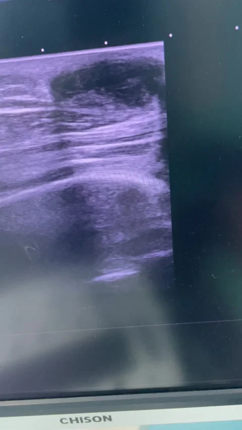 Subcutaneous Abscess Sonogram – Soft Tissue Ultrasound Examination 4K Vidéo 201499901