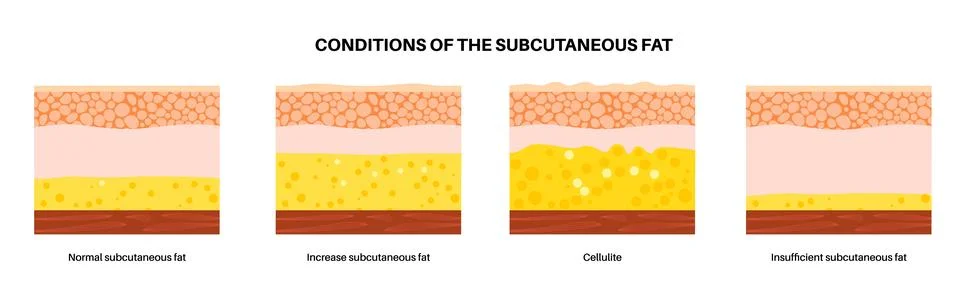 Subcutaneous fat level Stock Illustration