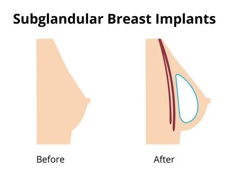 Subglandular breast implants placement before and after comparison Stock Illustration