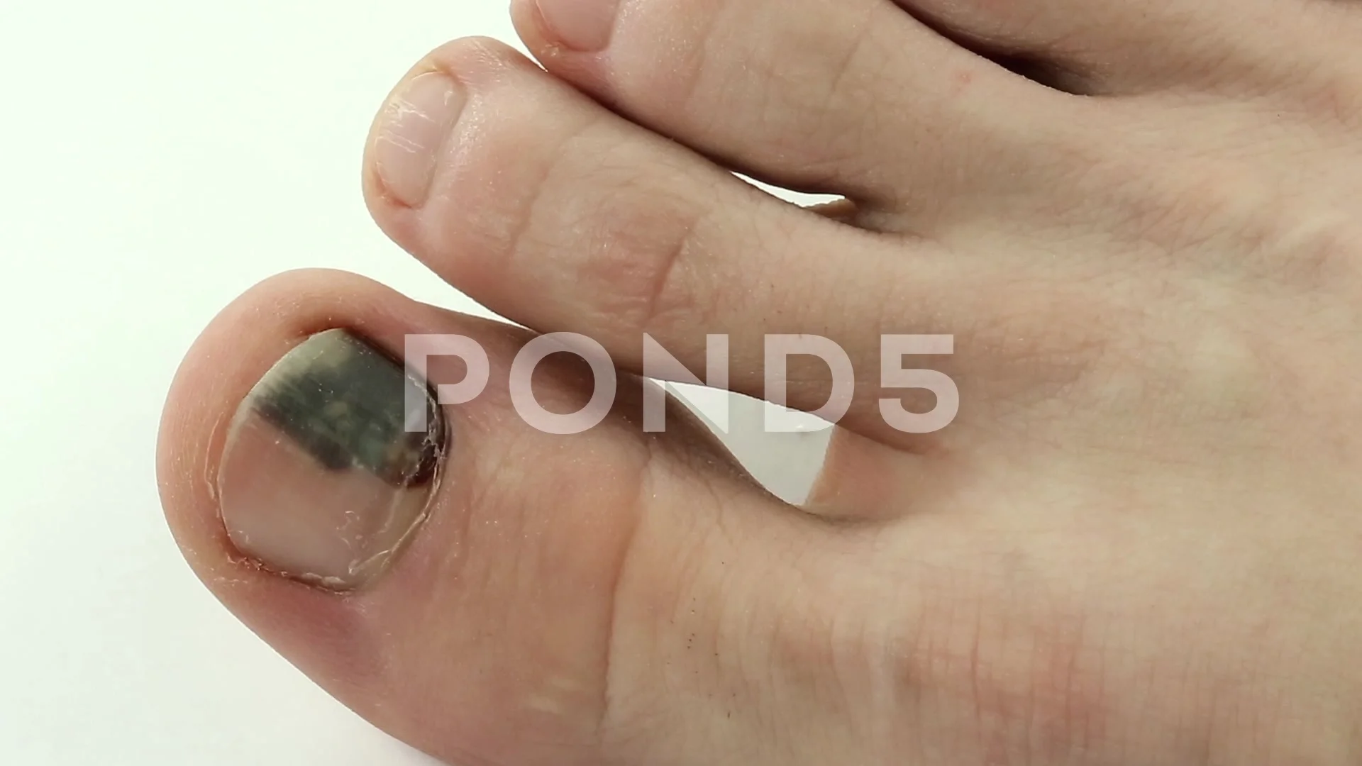Subungual Hematoma Bruise Under The Nail Of Toe Video 62793035