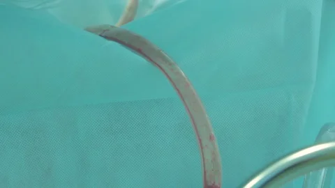 Suction fat during liposuction 스톡 동영상 70003361