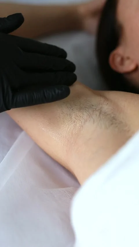 Sugaring: epilation with liquate sugar at armpit. Video stock 276545293
