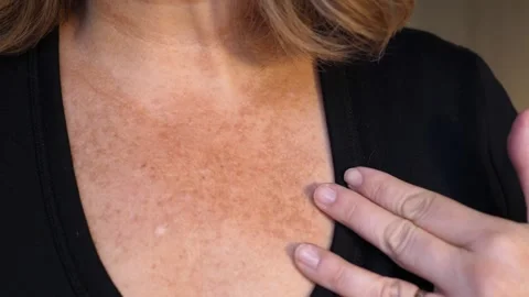 Sun damage on woman's neck and chest 動画素材 165554655