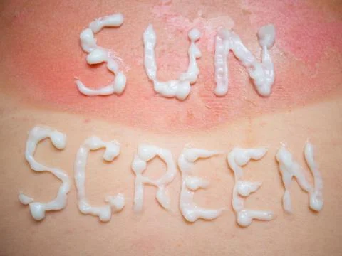 Sun screen burn Stock Photos