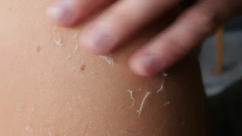 Sunburn, flaky skin, man scratching his back Видео 120130218