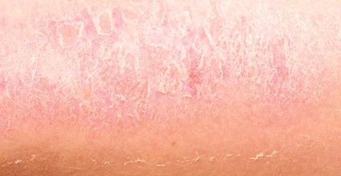 Sunburn Stock Photos