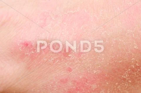 Sunburn Stock Photos