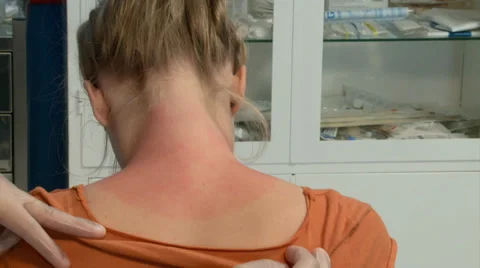 SUNBURN TREATMENT 스톡 동영상 35844468