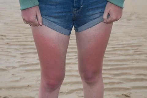 Sunburn. woman with massive sunburn on her legs Stock Photos